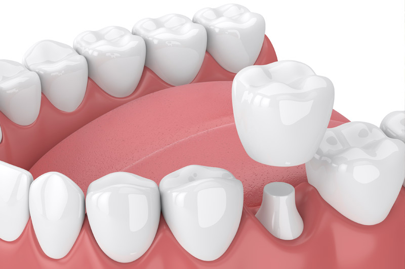 Dental Crowns in Pembroke Pines