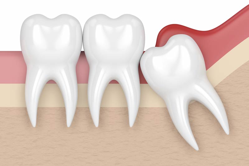Wisdom Tooth Removal in Pembroke Pines