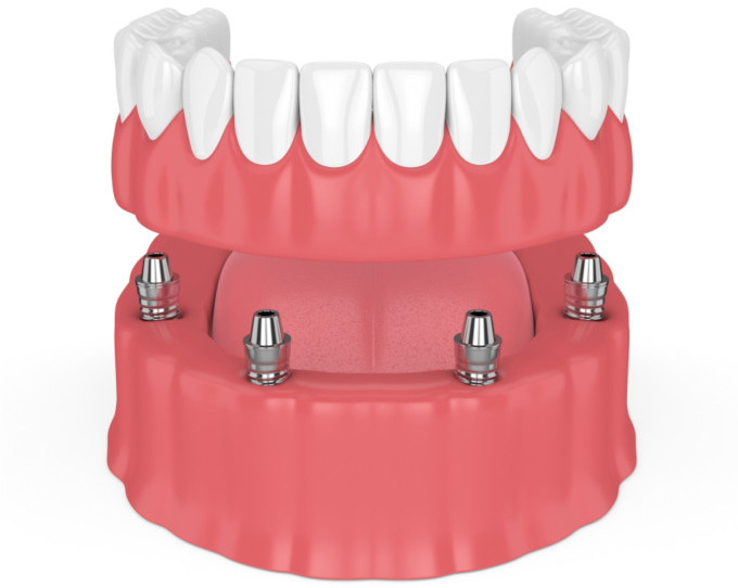 all on 4 diagram illustration of teeth