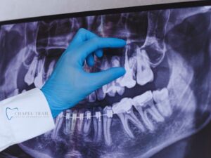 Root Canal Pembroke Pines